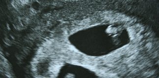 vanishing twin syndrome